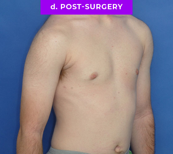 FEMALE-TO-MALE CHEST CONTOURING Patient 10 After 2