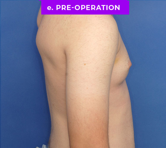 FEMALE-TO-MALE CHEST CONTOURING Patient 10 Before 3