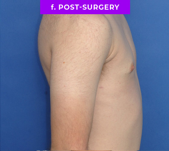 FEMALE-TO-MALE CHEST CONTOURING Patient 10 After 3