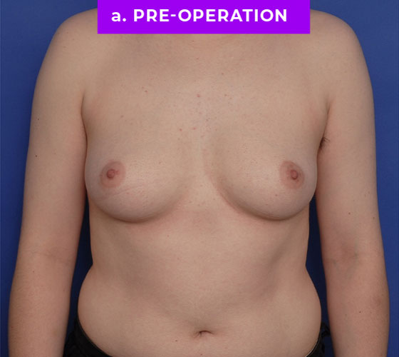 FEMALE-TO-MALE CHEST CONTOURING Patient 11 Before