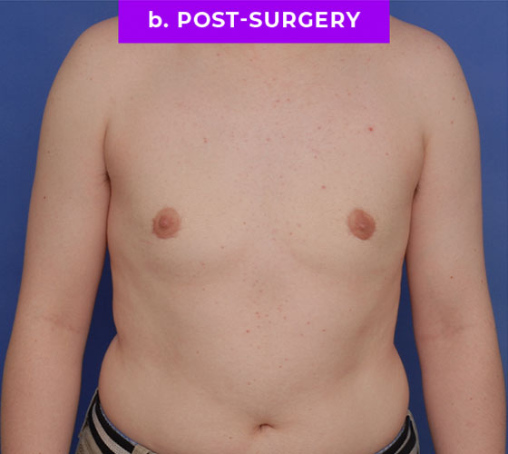 FEMALE-TO-MALE CHEST CONTOURING Patient 11 After