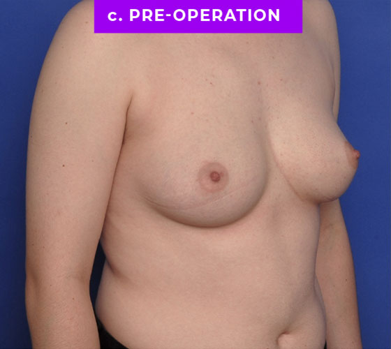 FEMALE-TO-MALE CHEST CONTOURING Patient 11 Before 2