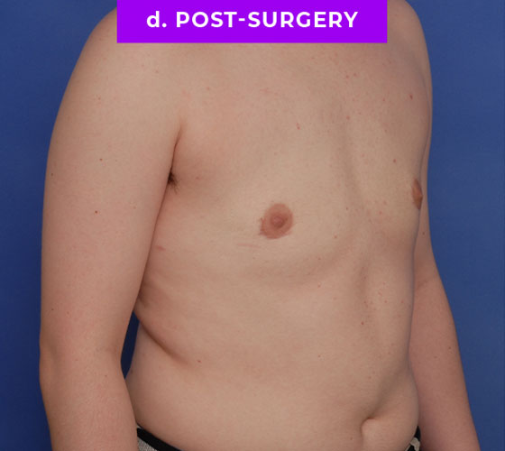 FEMALE-TO-MALE CHEST CONTOURING Patient 11 After 2