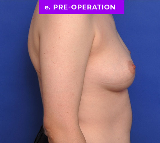 FEMALE-TO-MALE CHEST CONTOURING Patient 11 Before 3