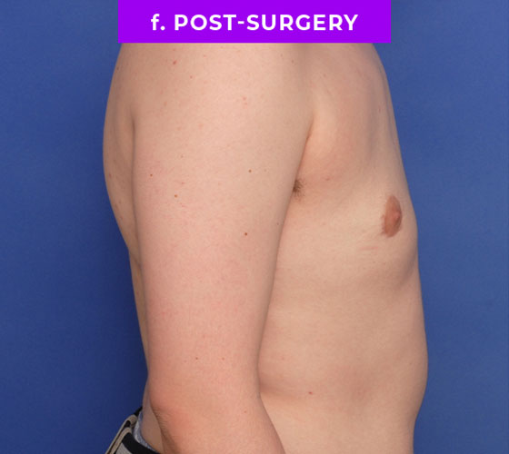 FEMALE-TO-MALE CHEST CONTOURING Patient 11 After 3