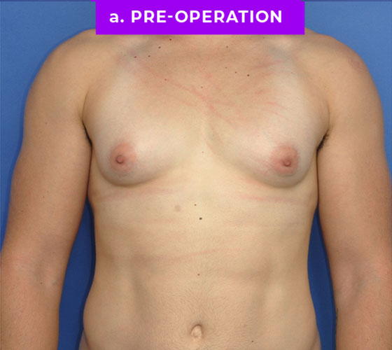 FEMALE-TO-MALE CHEST CONTOURING Patient 12 Before
