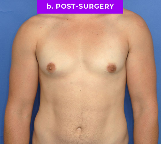 FEMALE-TO-MALE CHEST CONTOURING Patient 12 After