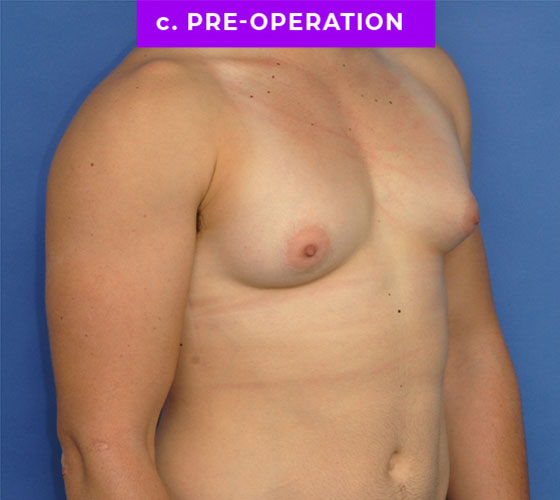 FEMALE-TO-MALE CHEST CONTOURING Patient 12 Before 2