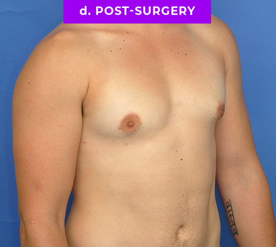 FEMALE-TO-MALE CHEST CONTOURING Patient 12 After 2