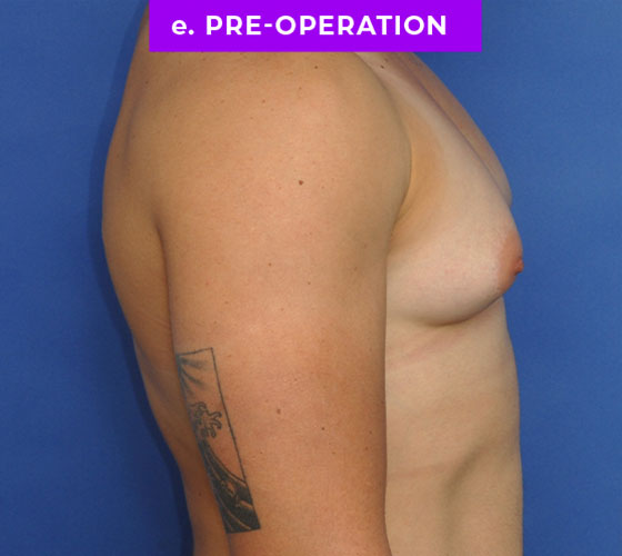 FEMALE-TO-MALE CHEST CONTOURING Patient 12 Before 3