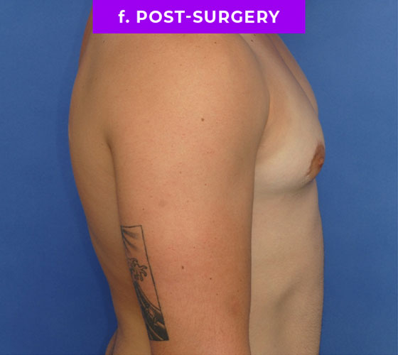 FEMALE-TO-MALE CHEST CONTOURING Patient 12 After 3