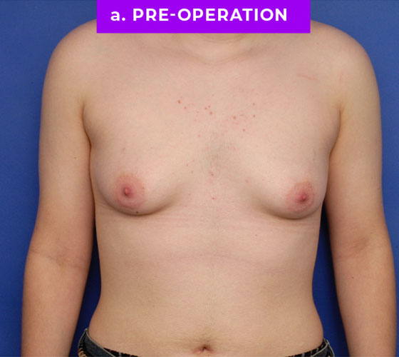 FEMALE-TO-MALE CHEST CONTOURING Patient 13 Before