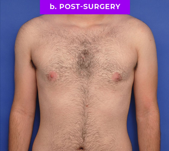 FEMALE-TO-MALE CHEST CONTOURING Patient 13 After