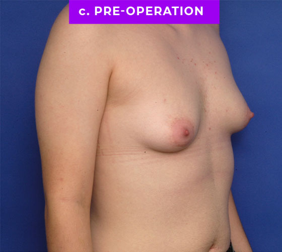 FEMALE-TO-MALE CHEST CONTOURING Patient 13 Before 2