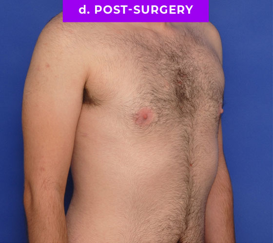 FEMALE-TO-MALE CHEST CONTOURING Patient 13 After 2