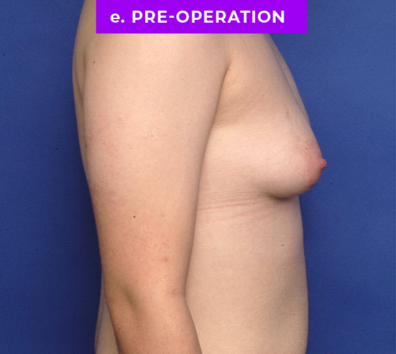 FEMALE-TO-MALE CHEST CONTOURING Patient 13 Before 3