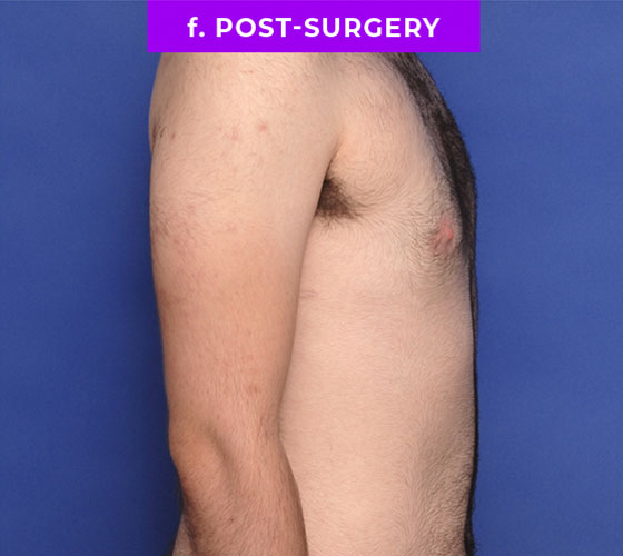 FEMALE-TO-MALE CHEST CONTOURING Patient 13 After 3