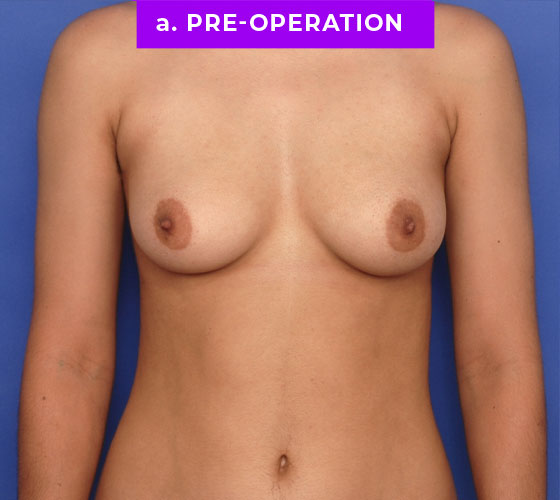 FEMALE-TO-MALE CHEST CONTOURING Patient 14 Before