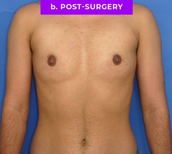 FEMALE-TO-MALE CHEST CONTOURING Patient 14 After