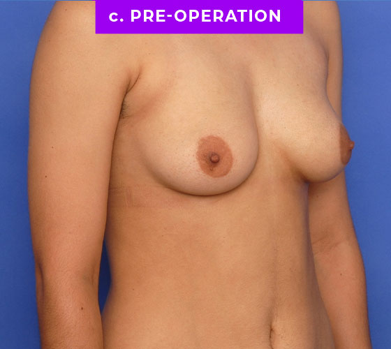FEMALE-TO-MALE CHEST CONTOURING Patient 14 Before 2