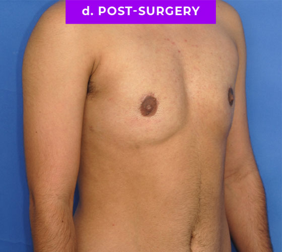 FEMALE-TO-MALE CHEST CONTOURING Patient 14 After 2