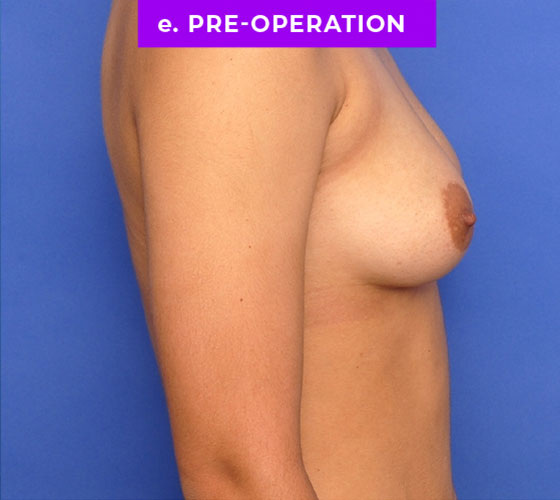 FEMALE-TO-MALE CHEST CONTOURING Patient 14 Before 3
