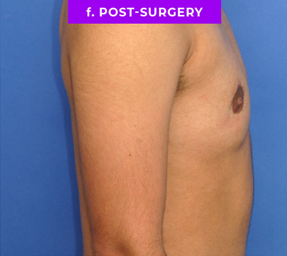 FEMALE-TO-MALE CHEST CONTOURING Patient 14 After 3