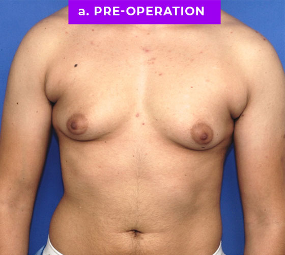 FEMALE-TO-MALE CHEST CONTOURING Patient 15 Before