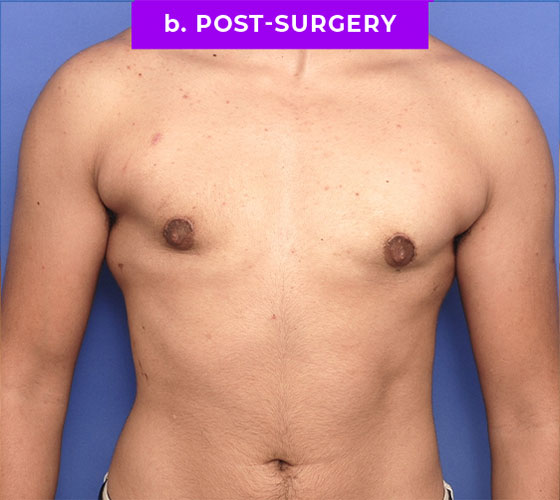 FEMALE-TO-MALE CHEST CONTOURING Patient 15 After