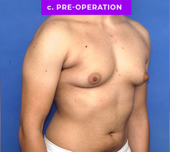 FEMALE-TO-MALE CHEST CONTOURING Patient 15 Before 2