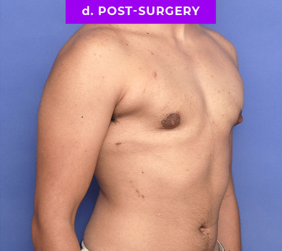 FEMALE-TO-MALE CHEST CONTOURING Patient 15 After 2