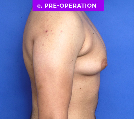 FEMALE-TO-MALE CHEST CONTOURING Patient 15 Before 3