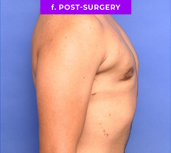 FEMALE-TO-MALE CHEST CONTOURING Patient 15 After 3