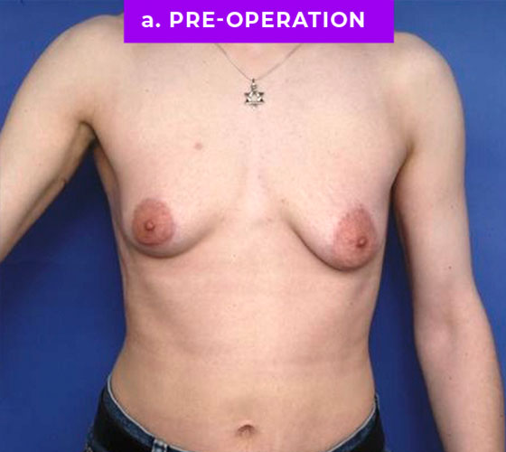 FEMALE-TO-MALE CHEST CONTOURING Patient 16 Before