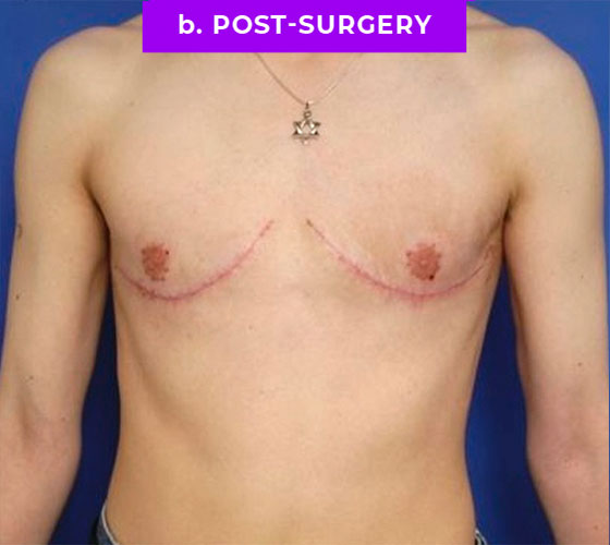 FEMALE-TO-MALE CHEST CONTOURING Patient 16 After