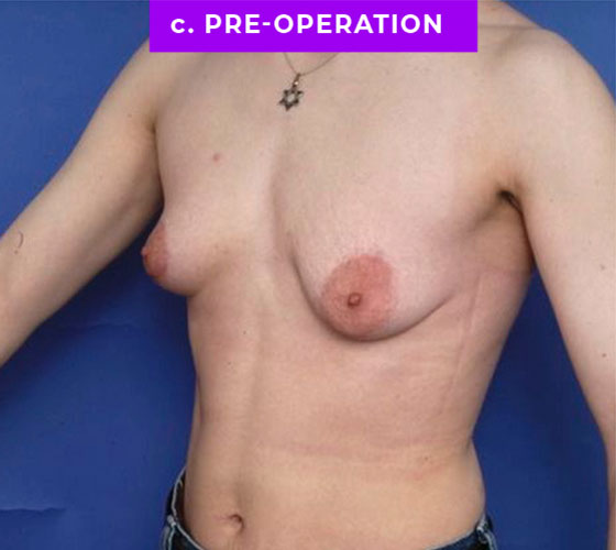 FEMALE-TO-MALE CHEST CONTOURING Patient 16 Before 2