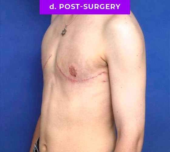 FEMALE-TO-MALE CHEST CONTOURING Patient 16 After 2