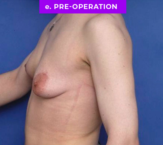 FEMALE-TO-MALE CHEST CONTOURING Patient 16 Before 3