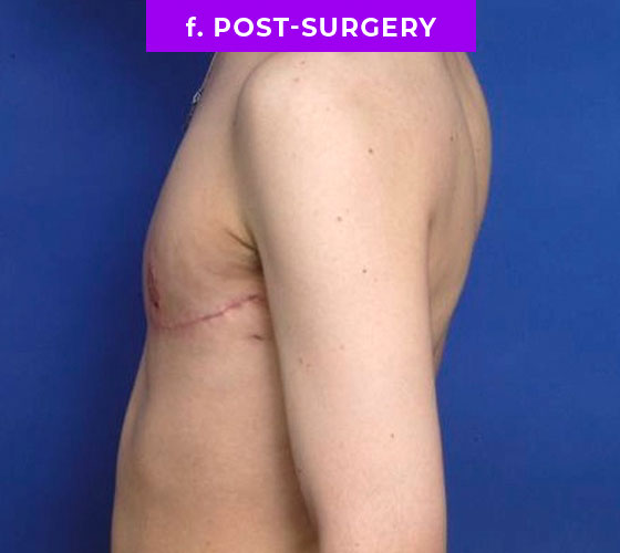 FEMALE-TO-MALE CHEST CONTOURING Patient 16 After 3