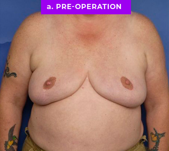 FEMALE-TO-MALE CHEST CONTOURING Patient 17 Before
