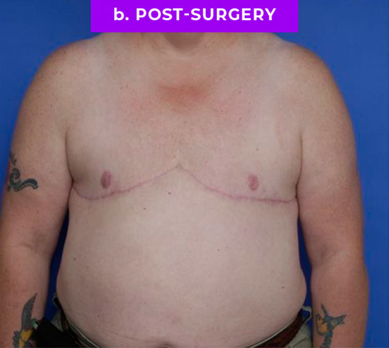 FEMALE-TO-MALE CHEST CONTOURING Patient 17 After