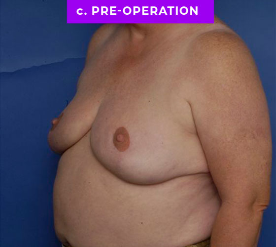 FEMALE-TO-MALE CHEST CONTOURING Patient 17 Before 2
