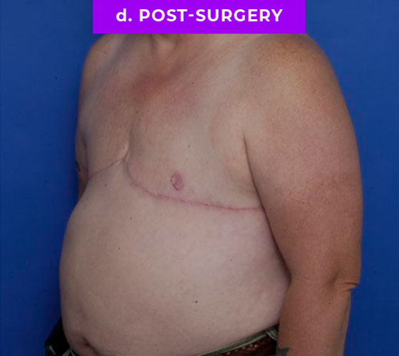 FEMALE-TO-MALE CHEST CONTOURING Patient 17 After 2