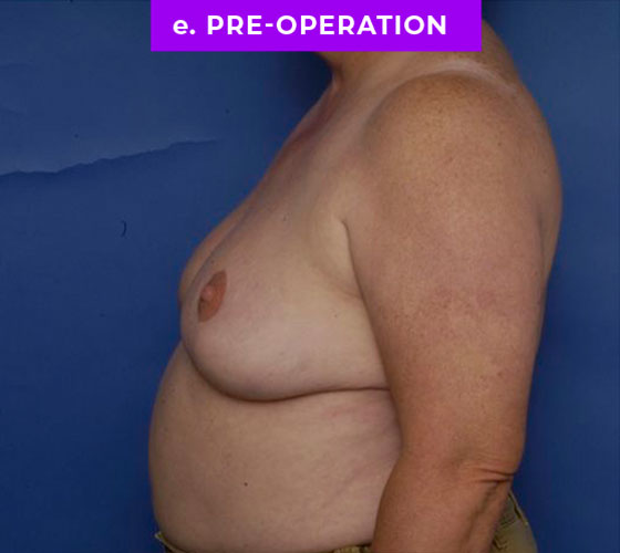 FEMALE-TO-MALE CHEST CONTOURING Patient 17 Before 3