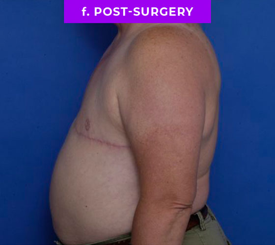 FEMALE-TO-MALE CHEST CONTOURING Patient 17 After 3