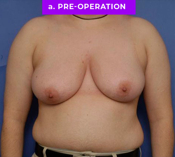 FEMALE-TO-MALE CHEST CONTOURING Patient 18 Before