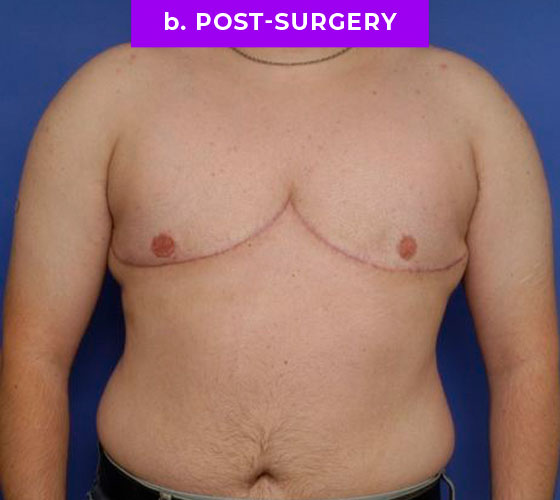 FEMALE-TO-MALE CHEST CONTOURING Patient 18 After