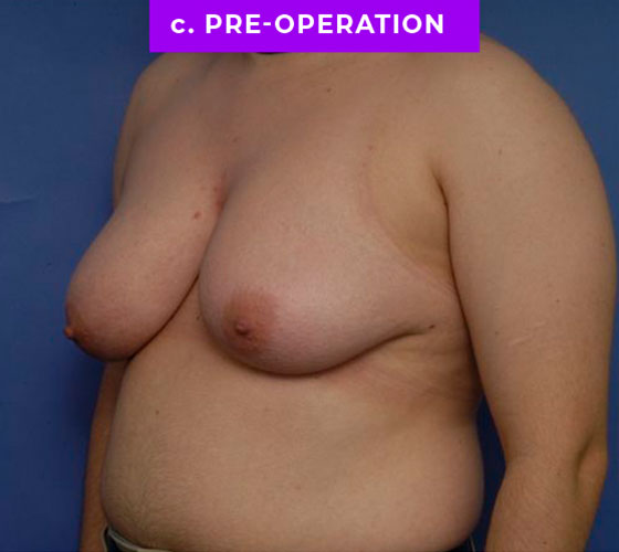 FEMALE-TO-MALE CHEST CONTOURING Patient 18 Before 2