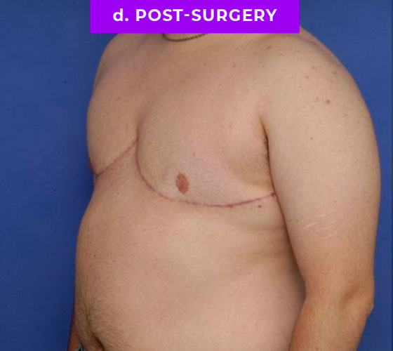 FEMALE-TO-MALE CHEST CONTOURING Patient 18 After 2