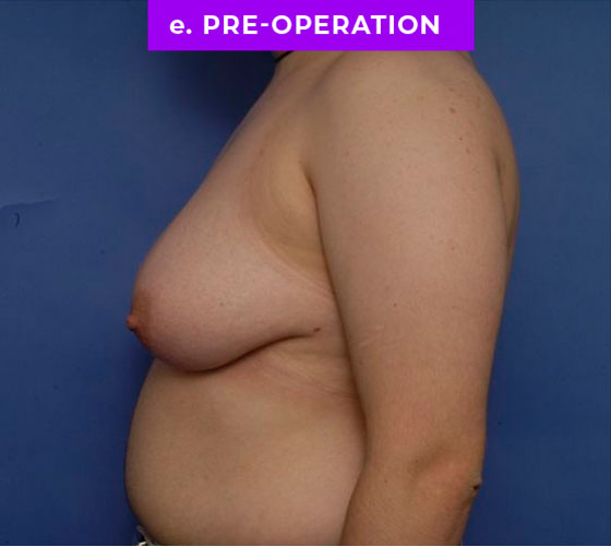 FEMALE-TO-MALE CHEST CONTOURING Patient 18 Before 3